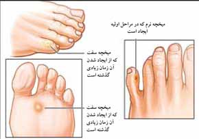 میخچه ضایعه‌ای پینه‌ای‌شکل از پوست مرده است