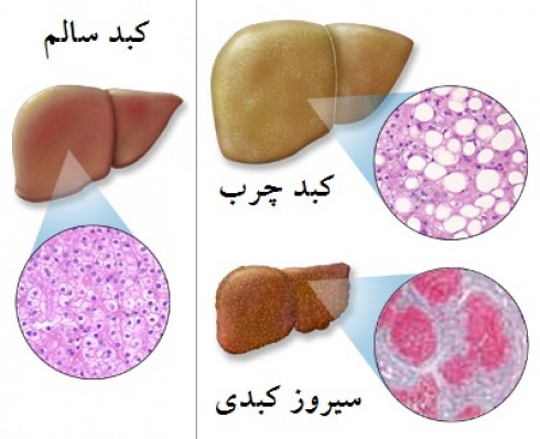 چطور بفهمیم کبدمان چرب است؟