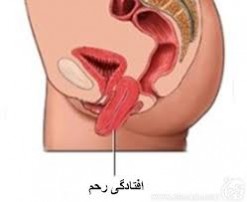 رابطه افتادگی رحم و افزایش سن